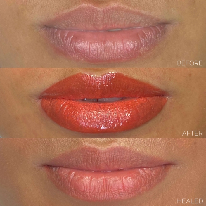 Lip Neutralization in a natural shade, correcting dark lip colour for a more even and balanced appearance